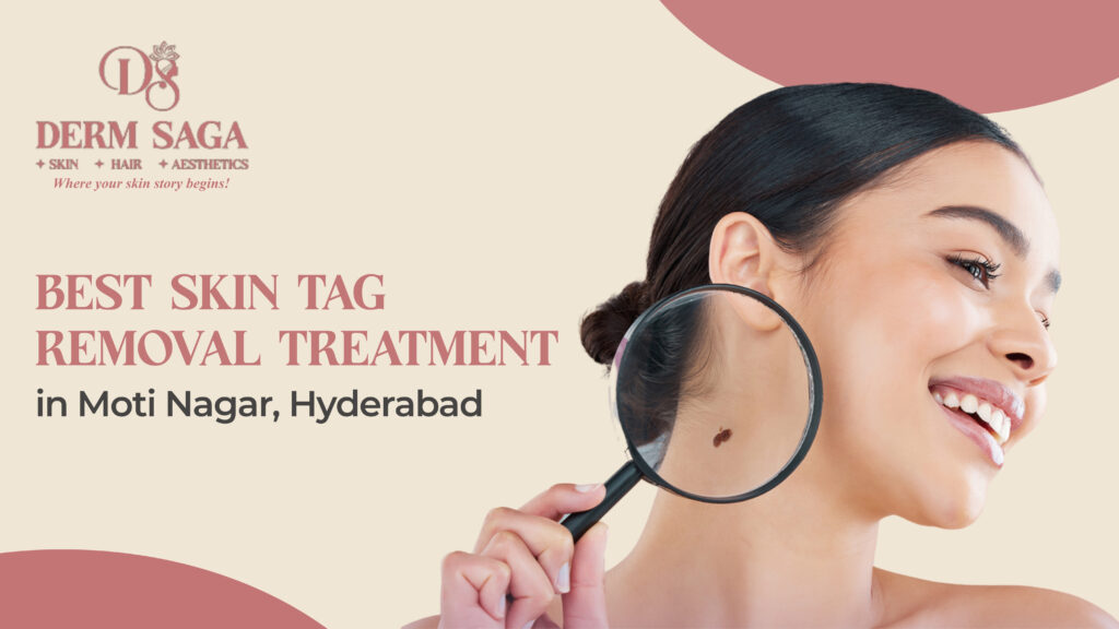 Best Skin Tag Removal Treatment in Moti Nagar