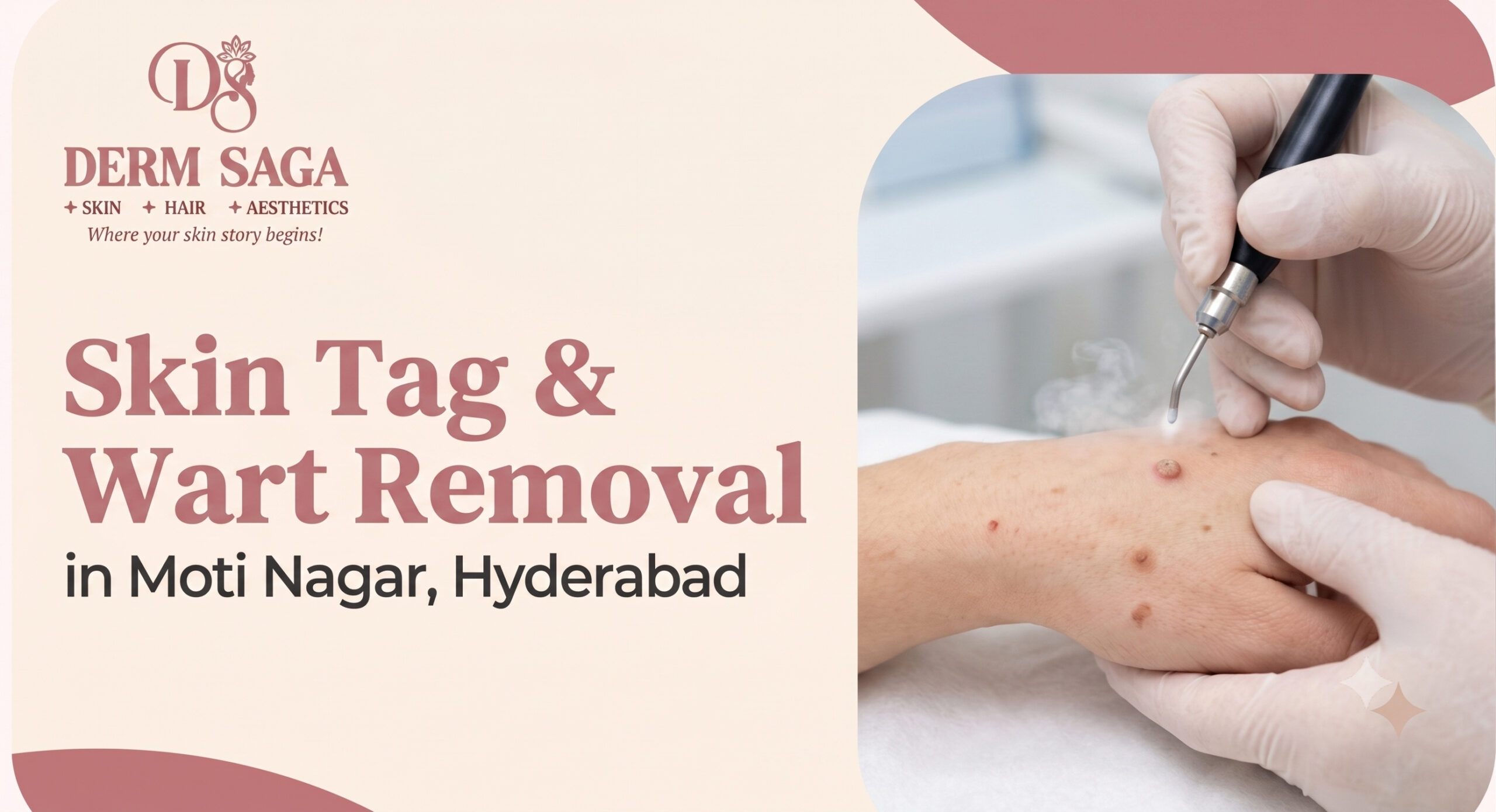 Skin Tag & Wart Removal in Moti Nagar, Hyderabad: Treatment Options, Safety & Aftercare